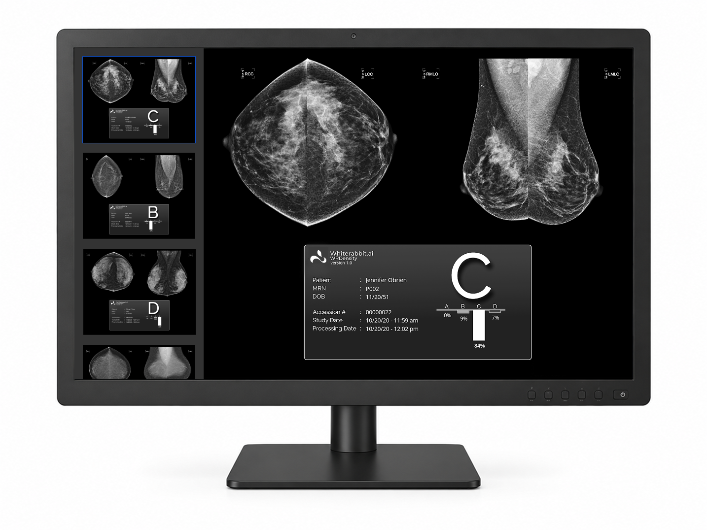 O software WRDensity da Whiterabbit.ai avalia automaticamente a densidade mamária em mamografias.