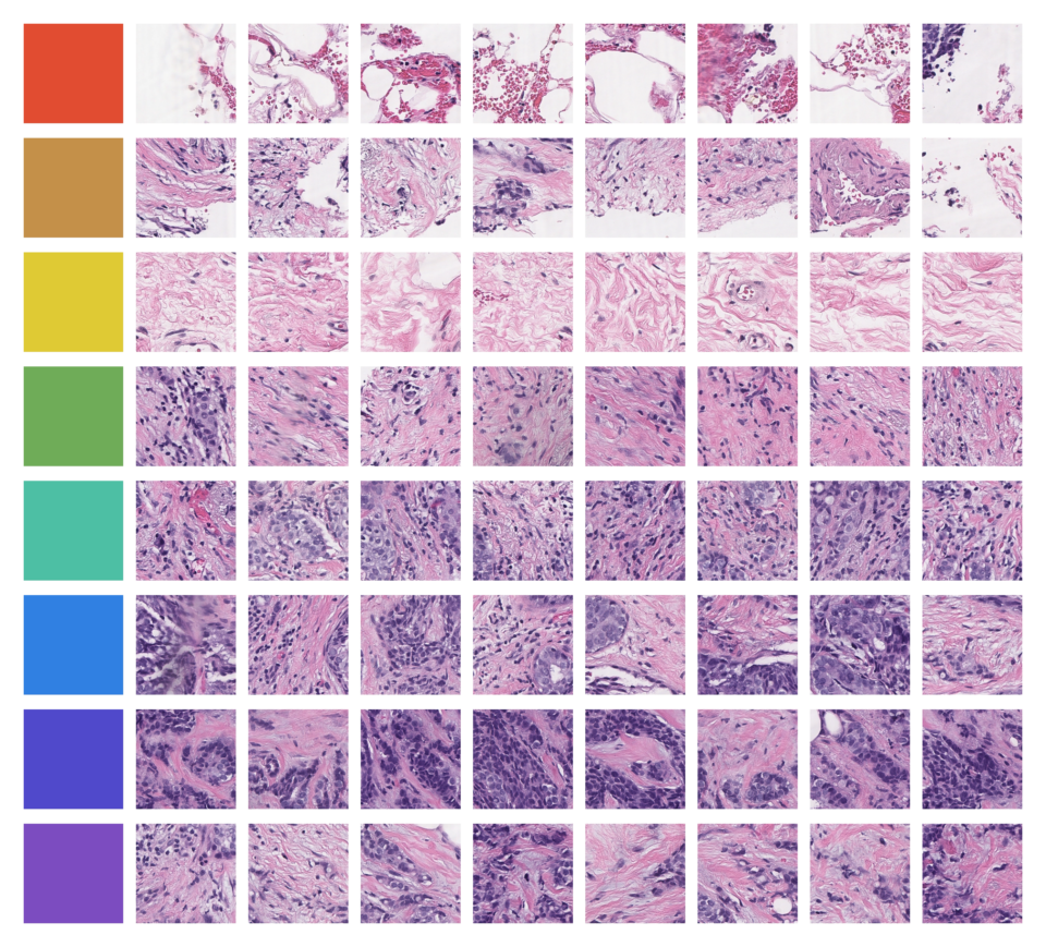 Os modelos de IA da Ataraxis interpretam padrões em lâminas de patologia, visualizados aqui como clusters codificados por cores.